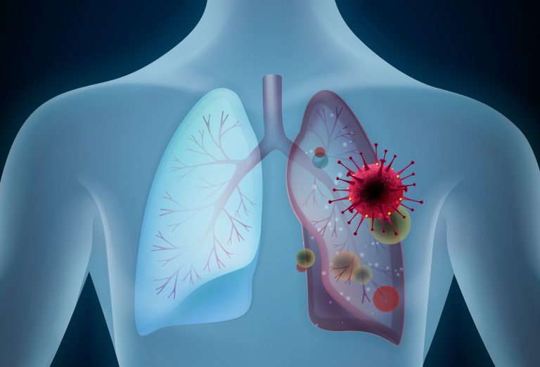 Como ajudar na prevenção da pneumonia hospitalar?
